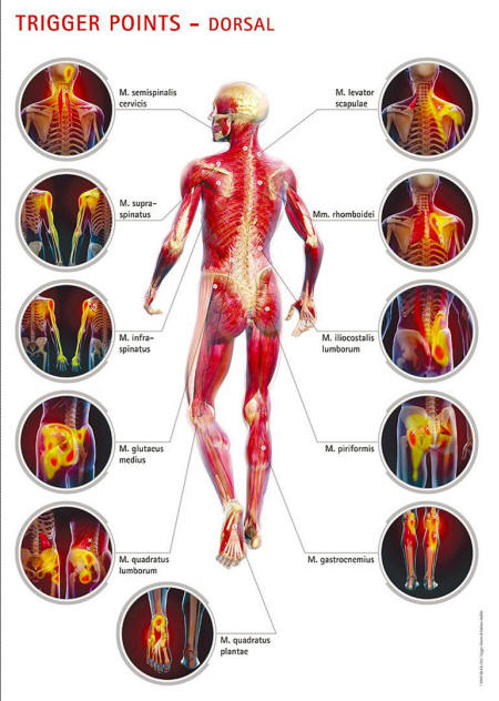 Trigger Points