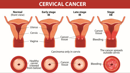 Symptoms of cervical cancer.