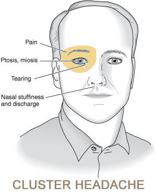 Cluster Headache